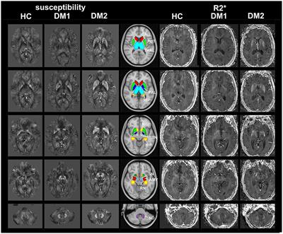 Characterization of Iron Accumulation in Deep Gray Matter in Myotonic Dystrophy Type 1 and 2 Using Quantitative Susceptibility Mapping and R2* Relaxometry: A Magnetic Resonance Imaging Study at 3 Tesla